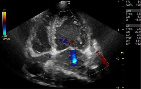Echocardiography features of non-compaction cardiomyopathy | Medicina Intensiva