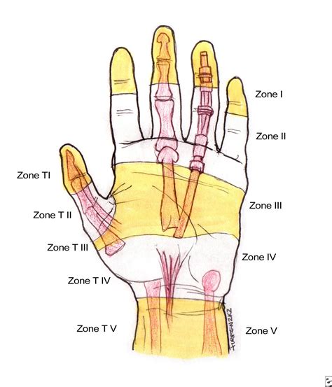 Flexor Tendon Hand Zones at Marsha Scott blog