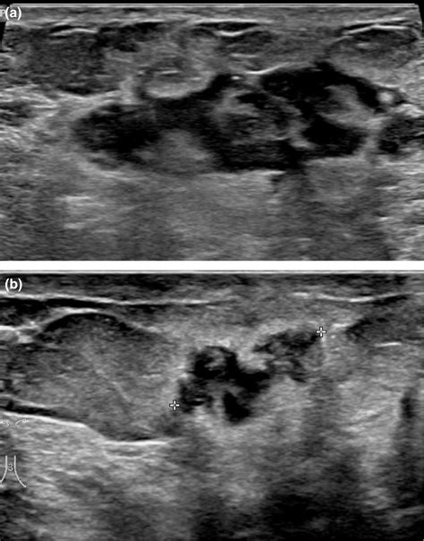Inflammatory Breast Cancer Ultrasound