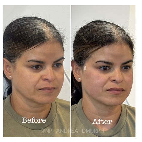 Andrea Dias Murphy | PDO threads are dissolvable surgical grade sutures that lie under the skin ...