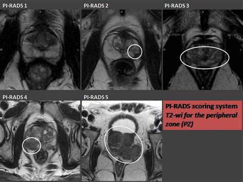 Presentation1, mri imaging of the prostate | PPTX