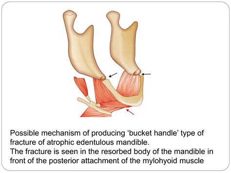 Mandibular-Fracture-1.pptx