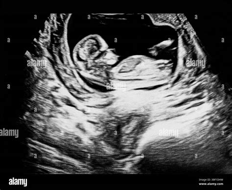 Earliest Sonogram For Pregnancy