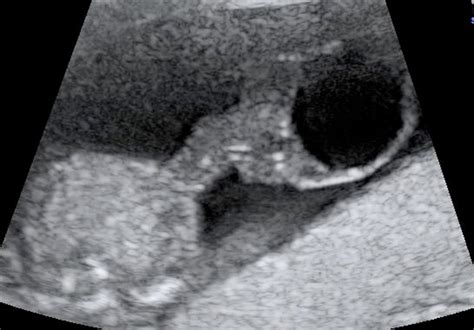Bildergebnis für umbilical cord ultrasound images