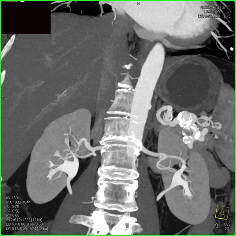 Splenic Artery Aneurysms - Vascular Radiology Case Studies - CTisus CT ...