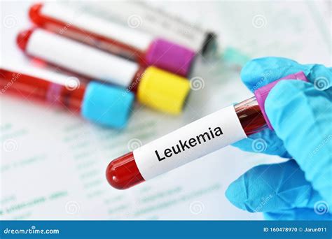 Blood for Leukemia Cells Test Stock Photo - Image of acute, hematopoiesis: 160478970