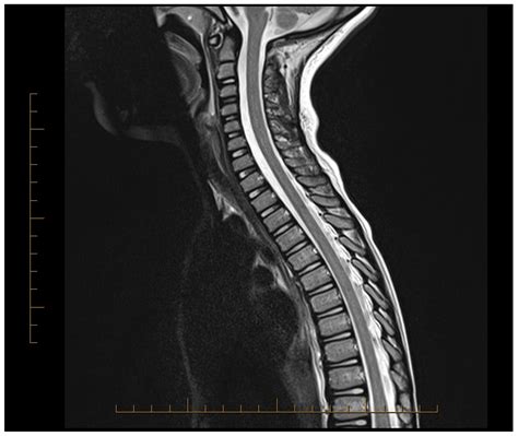Early Therapeutic Plasma Exchange in Pediatric Transverse Myelitis: A Case Report and Scoping Review