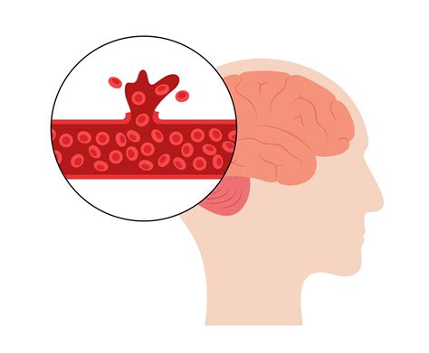 Brain Hemorrhage Bleeding Causes Symptoms Treatments