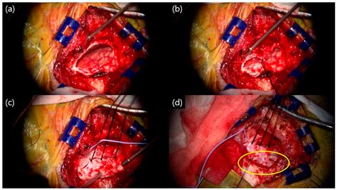 Microvascular Decompression Surgery