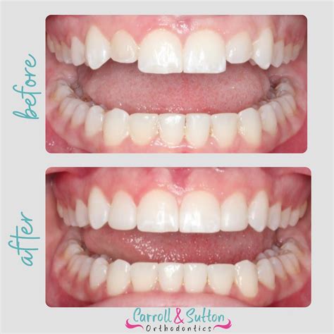 MARPE Procedure For Narrow Maxilla at our Orthodontic Dental Clinic