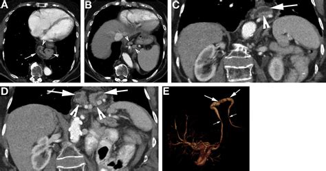 Pancreatic Duct Dilatation in Elderly Patient With Abdominal Pain - Gastroenterology