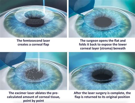 FAQ EVO ICL (Implantable Collamer Lens), LASIK Surgery