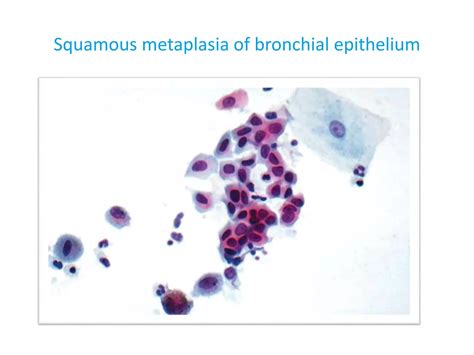 Cytology of BAL and Brushings | PPSX