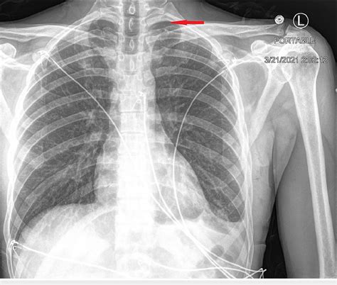 Hospital X-ray Chest 的图像结果
