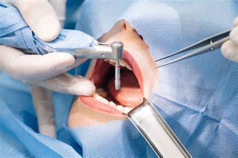 Dental Implant Procedure Steps