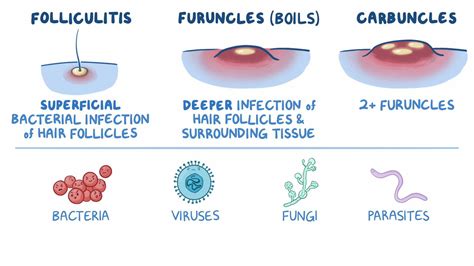 Folliculitis, carbuncles, and furuncles: Nursing - Osmosis Video Library