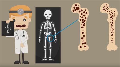 Osteoporosis: en qué consiste esta enfermedad y cuáles son los síntomas