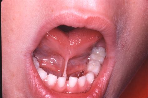 Types Of Tongue Tie Baby at Reynaldo Leahy blog