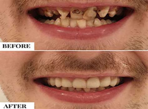 How Can Dentists Help You Cure Loose Teeth? - D. Dental