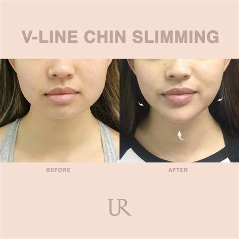 V-Line – Face Slimming using Botox (Asian Cosmetic Surgery) | Usha Rajagopal, MD