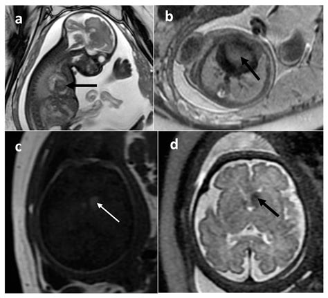Congenital Tumors—Magnetic Resonance Imaging Findings with Focus on ...