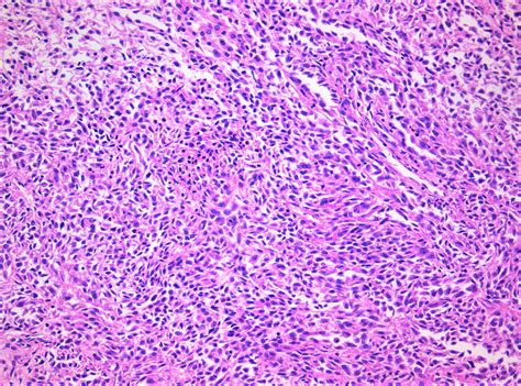 Spindle Cell Tumor