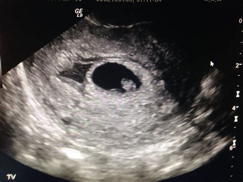 Subchorionic Hematoma Ultrasound Images