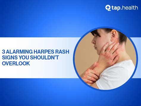 When to consult a professional for herpes skin rash
