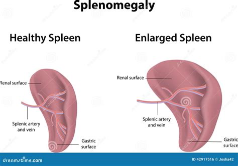 Splenomegaly stock vector. Image of enlargement, disease - 42917516
