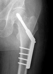 Hip Fractures | Trauma Surgery | Specialization | Procare Orthopaedic ...