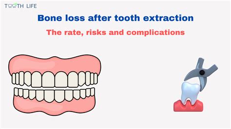 Bone Loss After Tooth Extraction: Rates, Risks, and Consequences