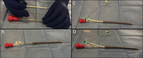 Inferior Vena Cava Filter Placement Through a Venovenous Extracorporeal Membrane Oxygenation ...