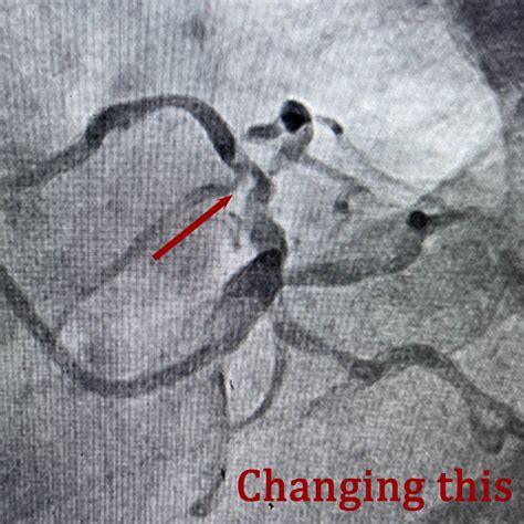 Dr. Benny Jose on LinkedIn: #postprandialangina #coronaryarterydisease #blockage #bloodvessels…