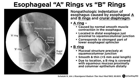 Z Line Esophagus