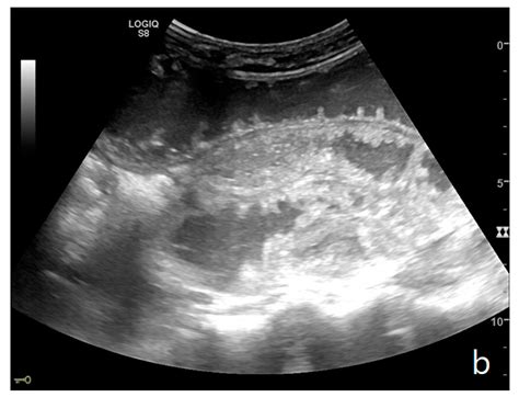 Ultrasound of Small Bowel Obstruction: A Pictorial Review