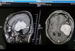 脑瘤 的图像结果