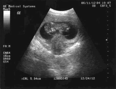孕31周，b超显示胎儿sd值增高，是什么意思？_今天做检查，_宝宝树