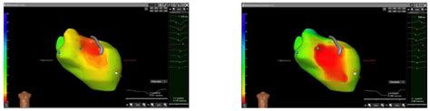 Noninvasive Mapping System for the Stereotactic Radioablation Treatment ...