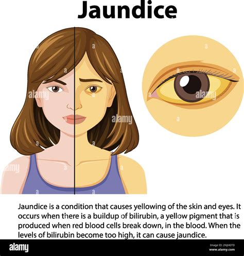Jaundice In Adults