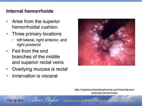 Kiss Your Hemorrhoids Goodbye: Surgical and Non-Surgical Management Options | PPTX