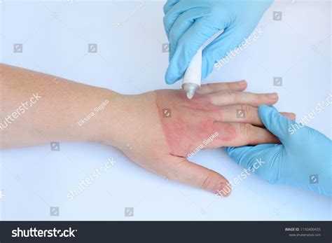 Rope Burn Hand Treatment at Anna Octoman blog