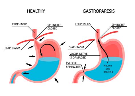 Gastroparesis And Life Expectancy