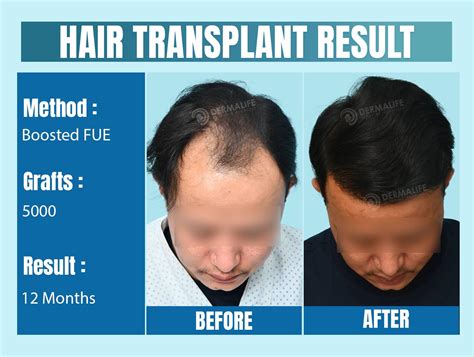 Hair Transplant Before After Result of Crown Area