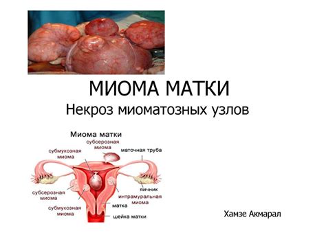 Миома матки. Некроз миоматозных узлов - online presentation