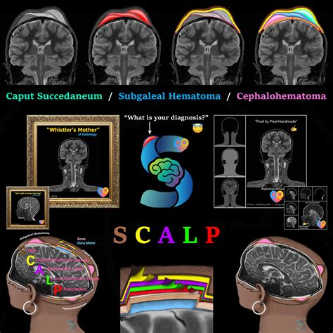 Caput Succedaneum Vs Cephalohematoma Why Does My Baby's Head Look