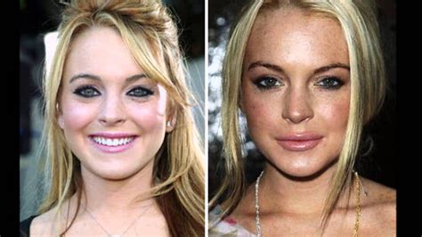 Bildergebnis für lip+fillers+for+celebrities