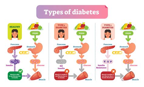The Difference between Type 1 and Type 2 Diabetes - Health BeatHealth Beat - difference between diabetes type 1 and 2