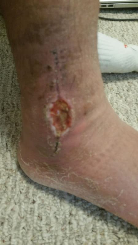 Ankle surgery with infected re-opened wound, 2 months passed | Ankle ...
