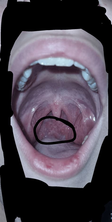 Small ulcer-like thing under tongue and lumps at the back of my throat that I have no clue about ...