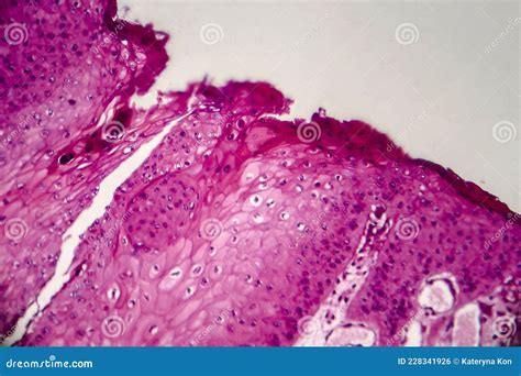 Condyloma Acuminatum, Also Known As Genital Warts, Light Micrograph ...